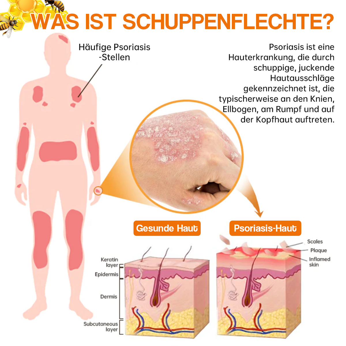 🔥Furzero™ Neuseeland Bienengift Psoriasis Behandlungsspray (Für alle Hautzustände geeignet)