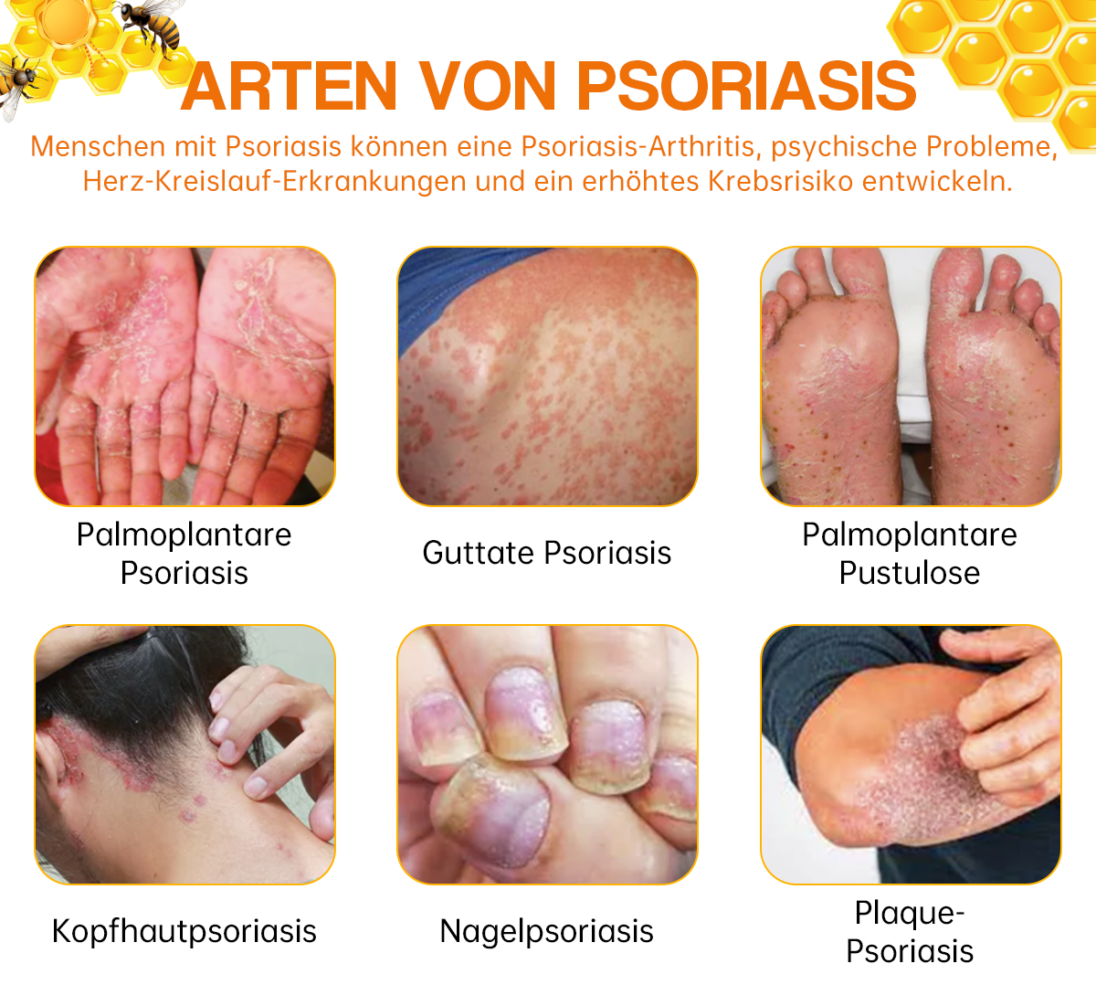 🔥Furzero™ Neuseeland Bienengift Psoriasis Behandlungsspray (Für alle Hautzustände geeignet)