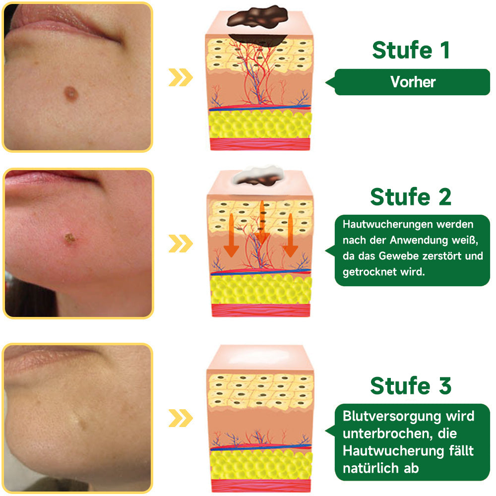 Furzero™ 20% Salicylsäure Hautbehandlungscreme ✔️ Dermatologisch geprüft ✔️ Sichere und schnell wirkende Formel ✔️ Hilft bei Warzen, Psoriasis, Ekzemen und mehr