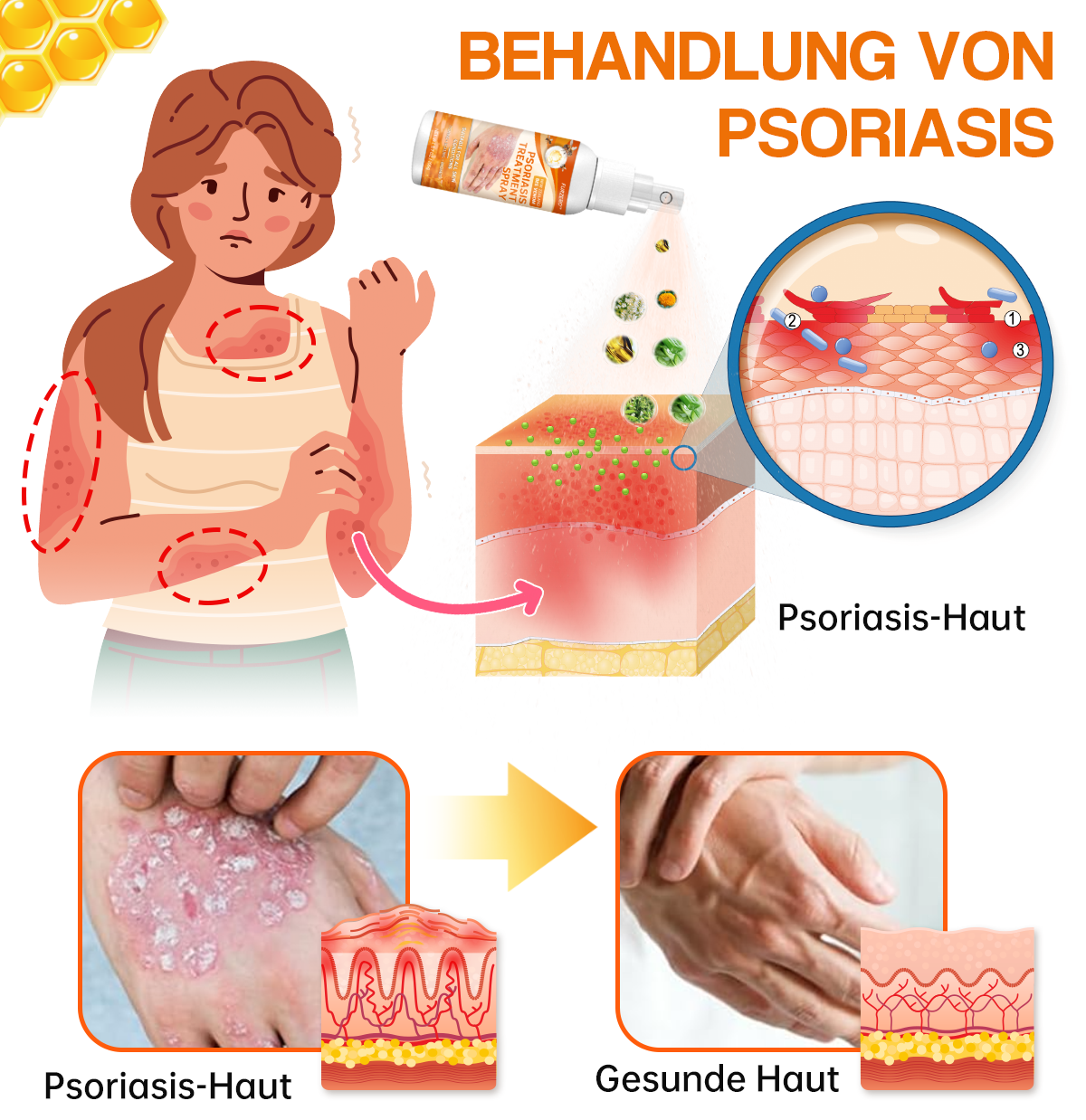 🔥Furzero™ Neuseeland Bienengift Psoriasis Behandlungsspray (Für alle Hautzustände geeignet)