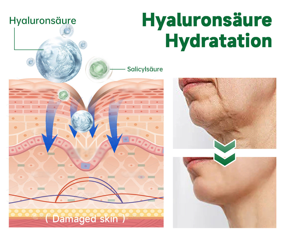 Furzero™ 20% Salicylsäure Hautbehandlungscreme ✔️ Dermatologisch geprüft ✔️ Sichere und schnell wirkende Formel ✔️ Hilft bei Warzen, Psoriasis, Ekzemen und mehr
