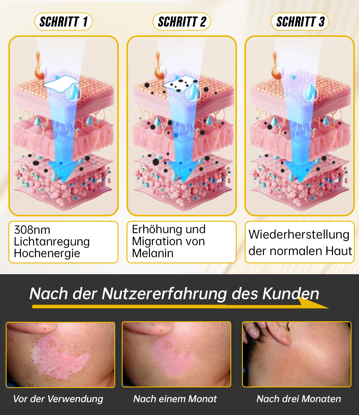 Ourlyard™ Psoriasis-Handgerät-UVB-Phototherapielampe (geeignet für alle Hauttypen)