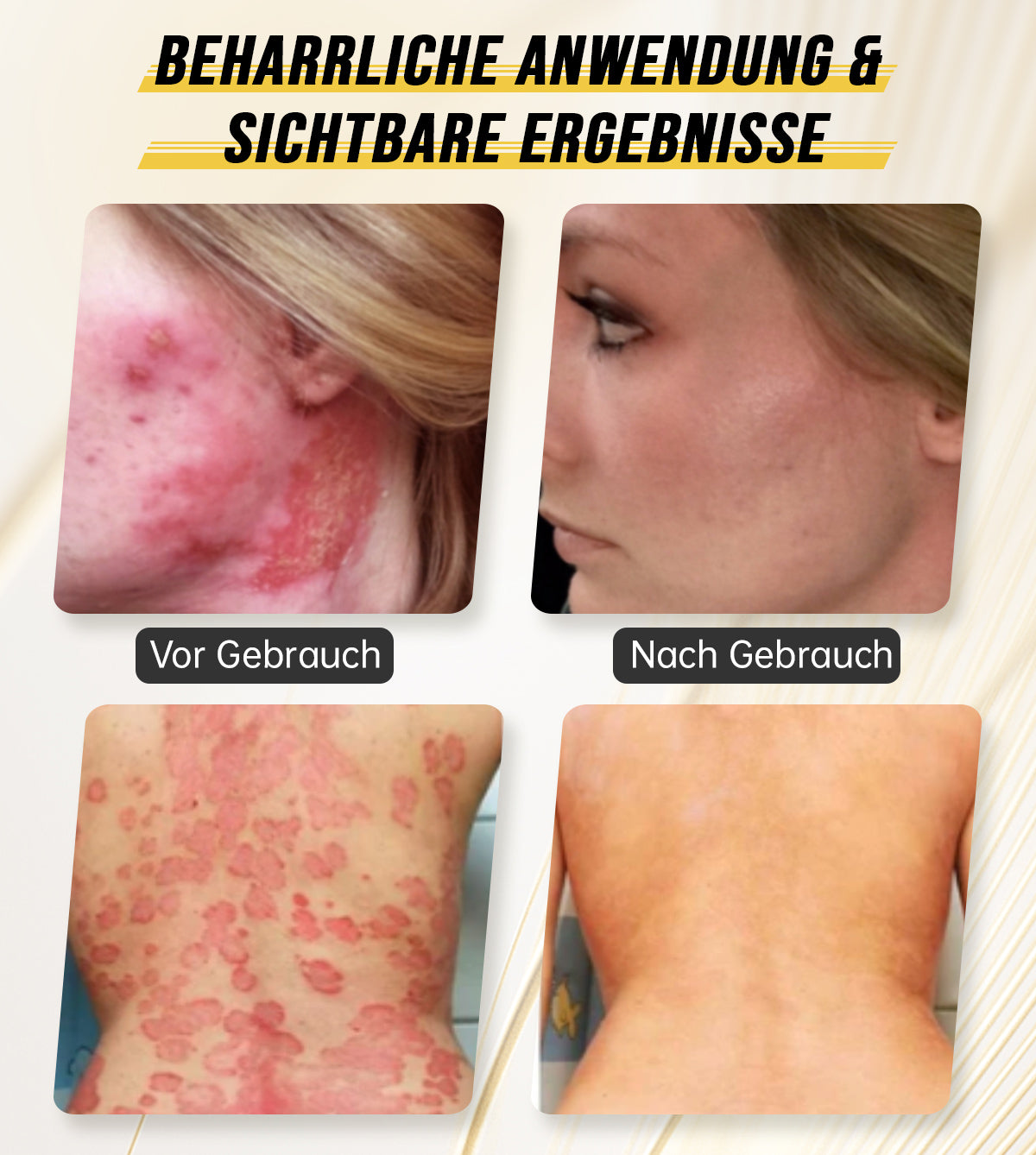 Ourlyard™ Psoriasis-Handgerät-UVB-Phototherapielampe (geeignet für alle Hauttypen)