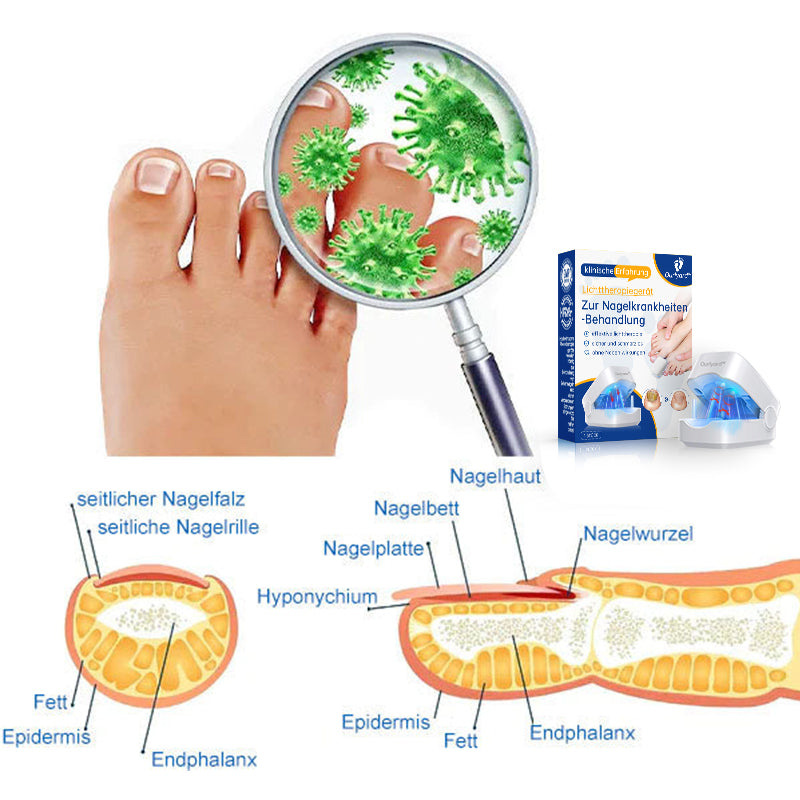 đ„đ„Ourlyardâą LeistungsfĂ€higes LichttherapiegerĂ€t zur Behandlung von Nagelerkrankungen
