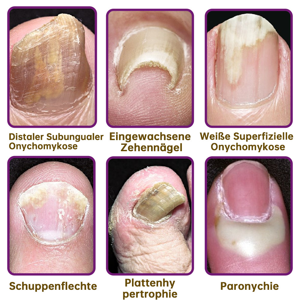 đflysmusâą FungiFree Bienengift Nagelbehandlungsserum