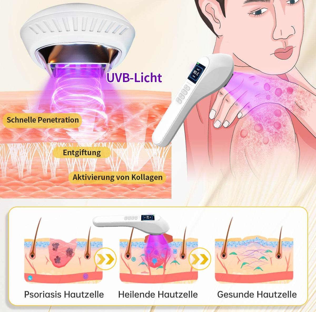 Ourlyard™ Psoriasis-Handgerät-UVB-Phototherapielampe (geeignet für alle Hauttypen)