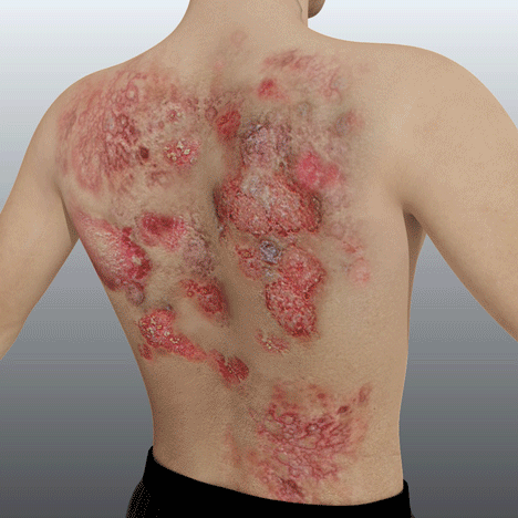 🔥Furzero™ Neuseeland Bienengift Psoriasis Behandlungsspray (Für alle Hautzustände geeignet)