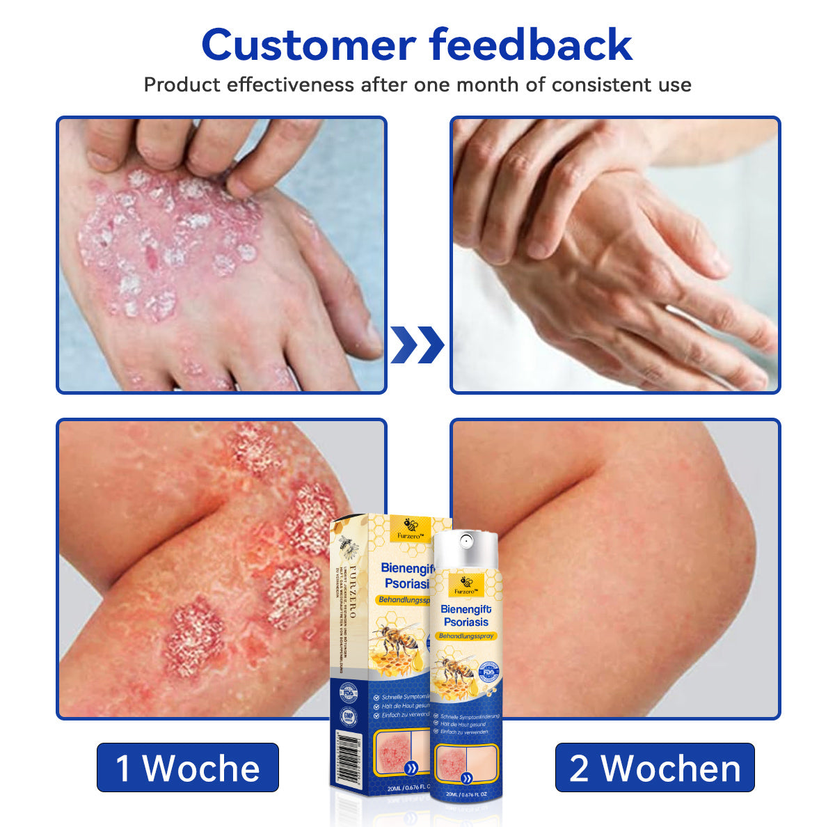 👏Furzero™ PsoriaHeal Bienengift Psoriasis Behandlungsspray(Geeignet für alle Hauttypen)