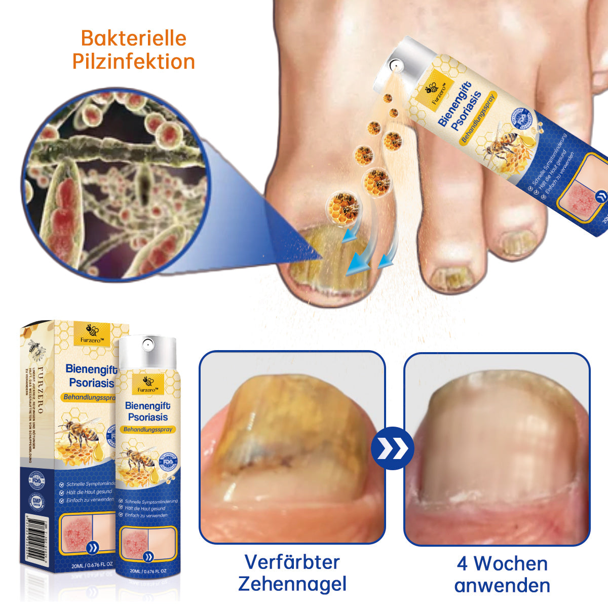 👏Furzero™ PsoriaHeal Bienengift Psoriasis Behandlungsspray(Geeignet für alle Hauttypen)