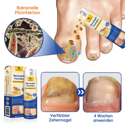 👏Furzero™ PsoriaHeal Bienengift Psoriasis Behandlungsspray(Geeignet für alle Hauttypen)