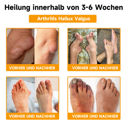 ✅Offizieller Shop:Furzero™ Bienengift- und Kurkuma-Gelenk- und Knochenschmerzlinderungscreme 👨‍⚕️Vom Deutsche Gesellschaft für Orthopädie und Unfallchirurgie (DGOU) genehmigt