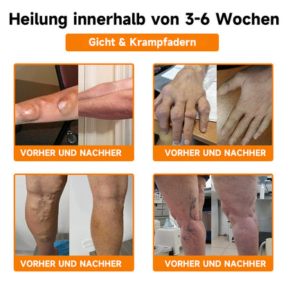 ✅Offizieller Shop:Furzero™ Bienengift- und Kurkuma-Gelenk- und Knochenschmerzlinderungscreme 👨‍⚕️Vom Deutsche Gesellschaft für Orthopädie und Unfallchirurgie (DGOU) genehmigt