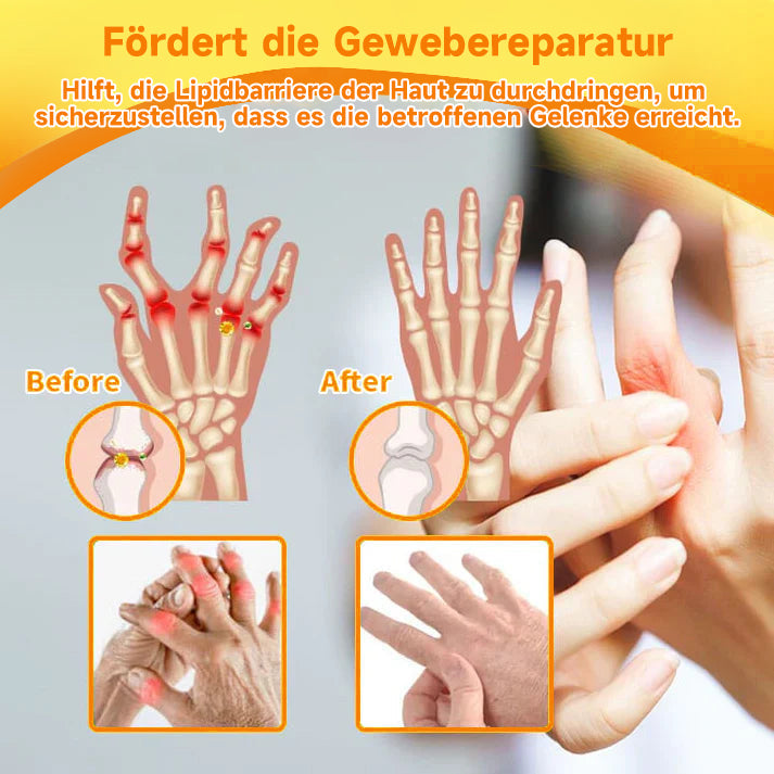 ✅Offizieller Shop:Furzero™ Bienengift- und Kurkuma-Gelenk- und Knochenschmerzlinderungscreme 👨‍⚕️Vom Deutsche Gesellschaft für Orthopädie und Unfallchirurgie (DGOU) genehmigt