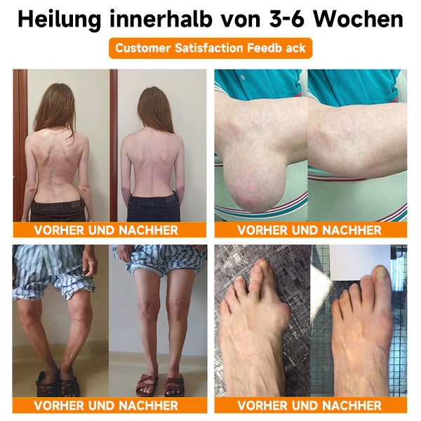 ✅Offizieller Shop:Furzero™ Bienengift- und Kurkuma-Gelenk- und Knochenschmerzlinderungscreme 👨‍⚕️Vom Deutsche Gesellschaft für Orthopädie und Unfallchirurgie (DGOU) genehmigt