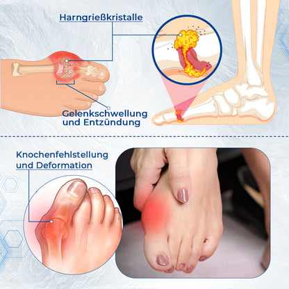 Sugoola™ Bunion Correction Kit:Lösen Sie leicht Ihre-Daumenschmerzen [ Keine Operation erforderlich ]