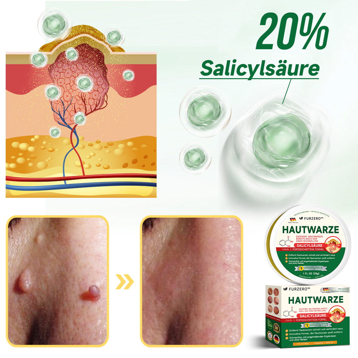 🌱Furzero™ 20% Salicylsäure Hautbehandlungscreme ✔️ Dermatologisch geprüft ✔️ Sichere und schnell wirkende Formel ✔️ Hilft bei Warzen, Psoriasis, Ekzemen und mehr