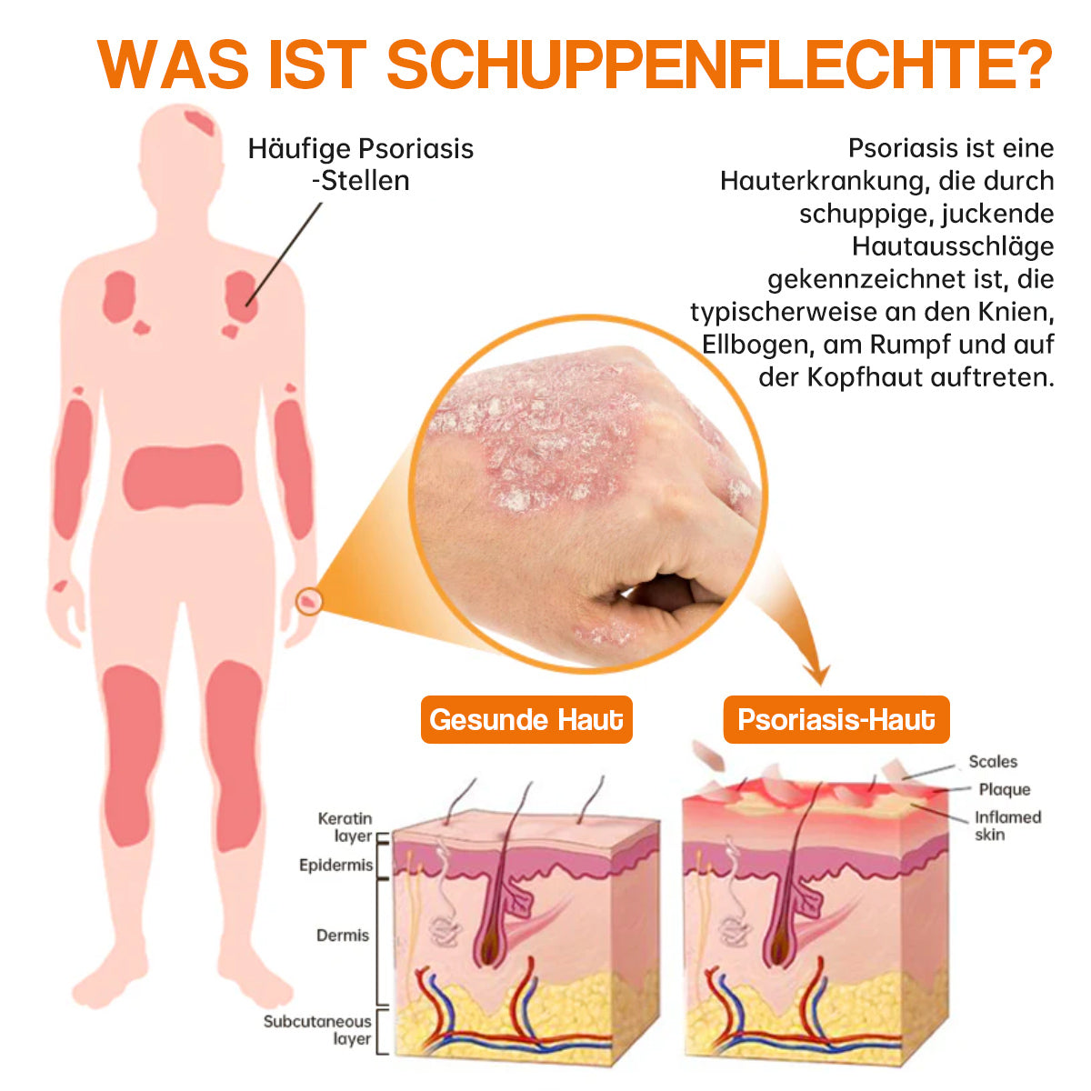 🐝🐝Furzero™ Neuseeland Bienengift Psoriasis-Behandlungscreme (Geeignet für alle Hautbedingungen)