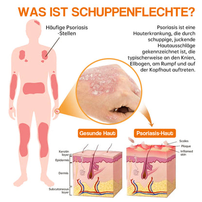 🐝🐝Furzero™ Neuseeland Bienengift Psoriasis-Behandlungscreme (Geeignet für alle Hautbedingungen)