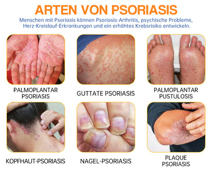 👏Furzero™ PsoriaHeal Bienengift Psoriasis Behandlungsspray(Geeignet für alle Hauttypen)