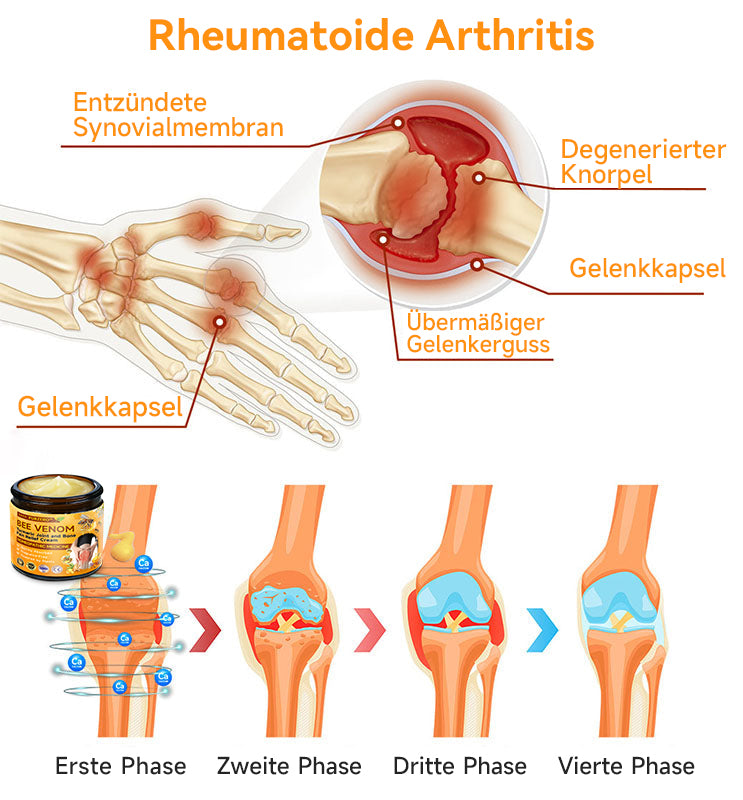 ✅Furzero™ Bienengift- und Kurkuma-Gelenk- und Knochenschmerzlinderungscreme (Spezialisiert auf Gelenk- und Arthritisbeschwerden & empfohlen von der AAOS)