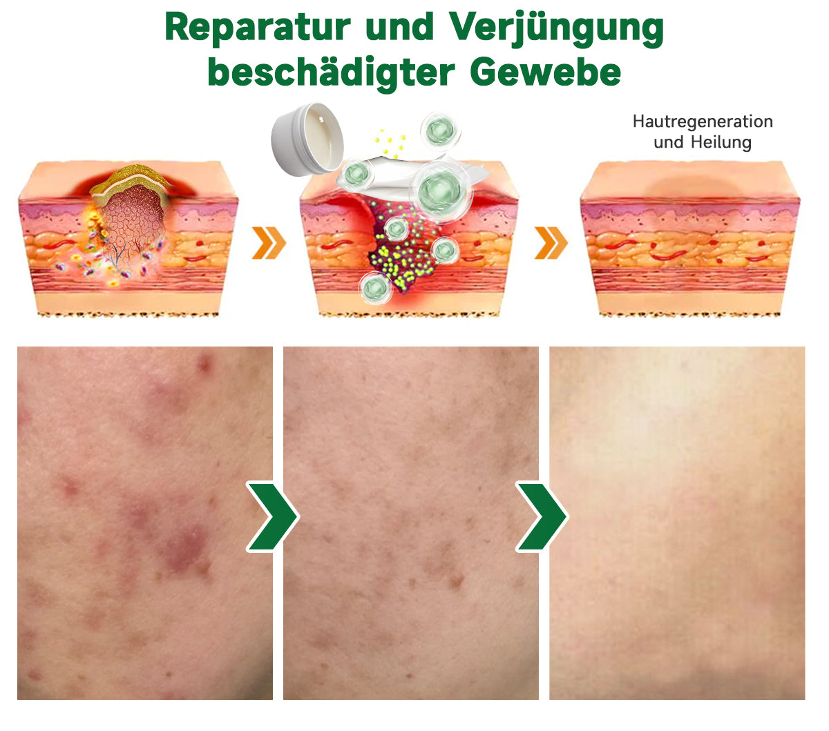 🌱🌱Furzero™ 20% Salicylsäure Hautbehandlungscreme ✔️ Dermatologisch geprüft ✔️ Sichere und schnell wirkende Formel ✔️ Hilft bei Warzen, Psoriasis, Ekzemen und mehr