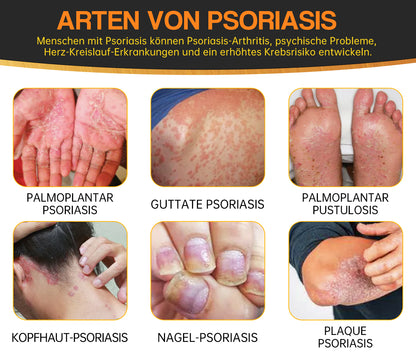 🐝🐝Furzero™ Neuseeland Bienengift Psoriasis-Behandlungscreme (Geeignet für alle Hautbedingungen)