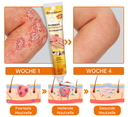 🐝🐝Furzero™ Neuseeland Bienengift Psoriasis-Behandlungscreme (Geeignet für alle Hautbedingungen)