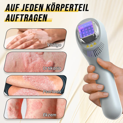 🔥🔥Ourlyard™ Psoriasis-Handgerät-UVB-Phototherapielampe (geeignet für alle Hauttypen)