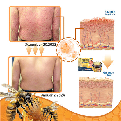 🌿Ourlyard™ Bienengift Advanced Psoriasis Behandlungssalbe (👨Vom Arzt empfohlen)