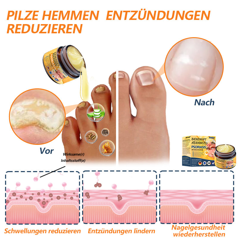 🌿🌿Ourlyard™ Bienengift Advanced Psoriasis Behandlungssalbe (👨Vom Arzt empfohlen)