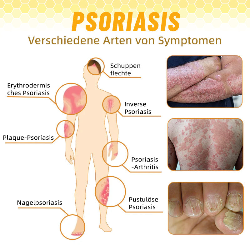 🧑‍⚕️Furzero™ Neuseeländisches Bienengift Psoriasis Behandlungsspray (Geeignet für alle Hauttypen)