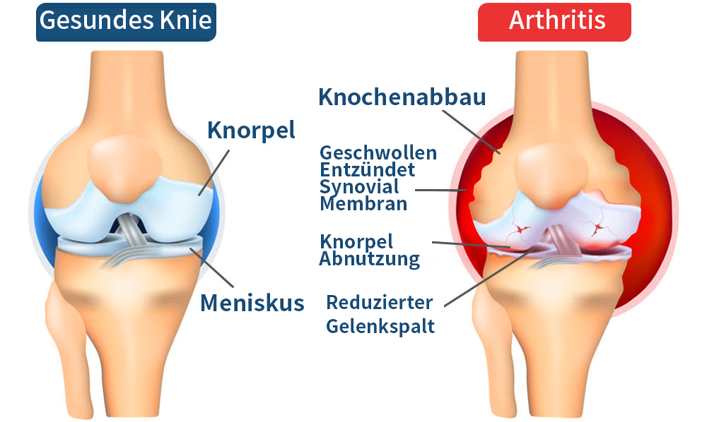 🐝 Ourlyard™ Neuseeland Bienenstich Gelenksentlastungsgel(Neuseeländischer Bienenextrakt – spezialisiert auf die Behandlung orthopädischer Erkrankungen und arthritischer Schmerzen)