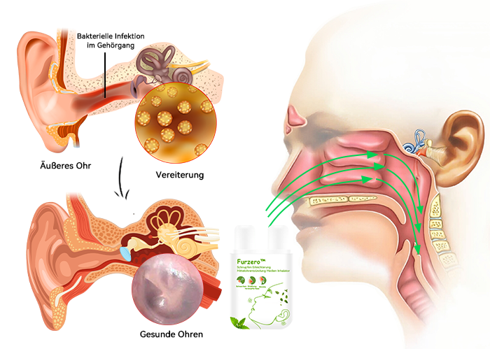 Furzero™ Schnupfen Erleichterung Mittelohrentzündung Medien Inhalator