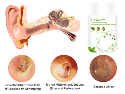 Furzero™ Schnupfen Erleichterung Mittelohrentzündung Medien Inhalator