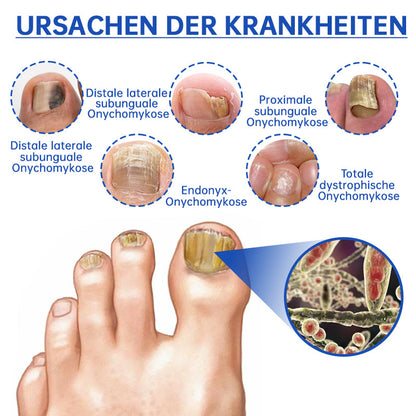 🌈Furzero™ PureNail Pilz-Lasertherapiegerät