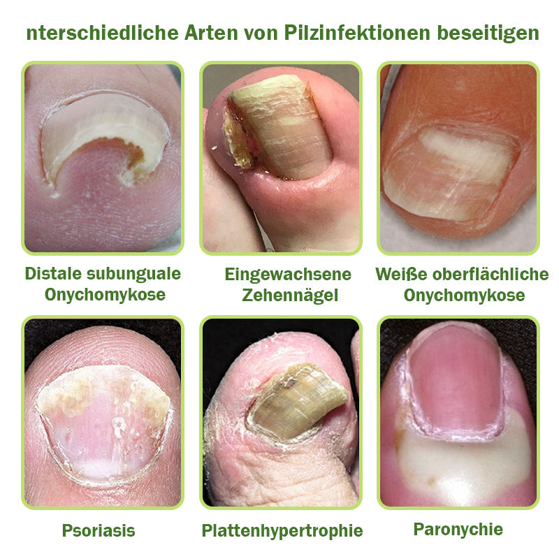 ✨Furzero™ Nagelverteidigung Bienengift-Behandlungsserum