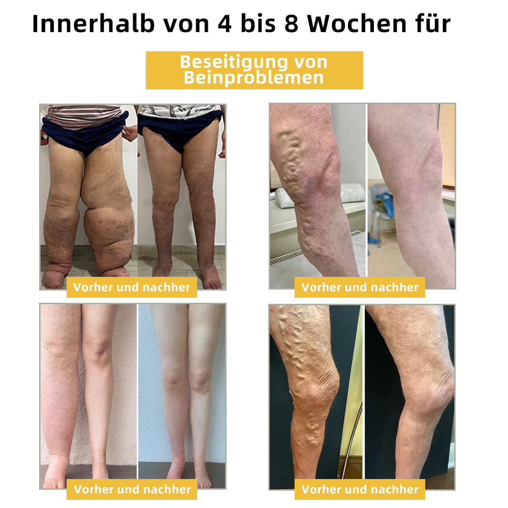 🔥🔥Sugoola™ 🐝Beim Venom Lymphtische Entwässerung & Schlankheits Fußbad Perlen🫚 - BMG Erwartete Empfehlungen👍