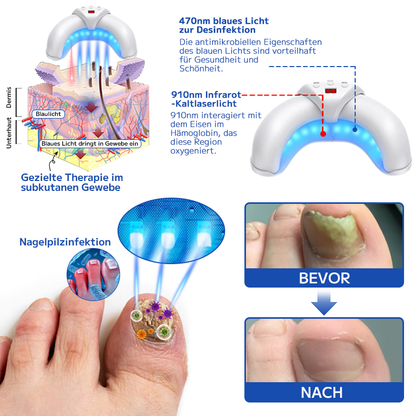 Furzero™ Effektive Pilz-Nagel-Behandlungs-Lasergerät