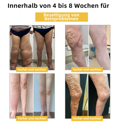 🔥🐝Sugoola™ Beim Venom Lymphtische Entwässerung & Schlankheits Fußbad Perlen🫚 - BMG Erwartete Empfehlungen👍