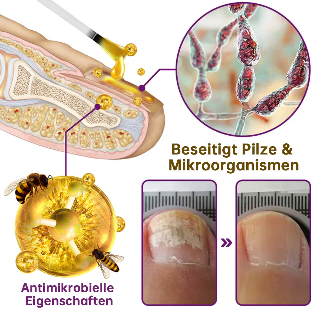 🐝🐝flysmus™ FungiFree Bienengift Nagelbehandlungsserum