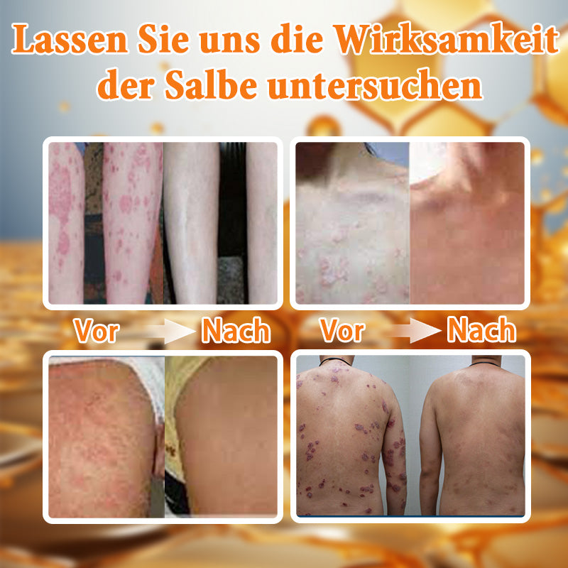 🌿🌿Ourlyard™ Bienengift Advanced Psoriasis Behandlungssalbe (👨Vom Arzt empfohlen)