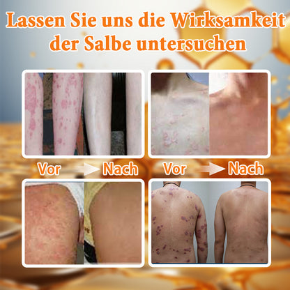 🌿Ourlyard™ Bienengift Advanced Psoriasis Behandlungssalbe (👨Vom Arzt empfohlen)