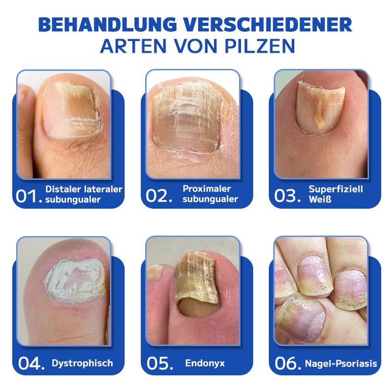 Furzero™ Effektive Pilz-Nagel-Behandlungs-Lasergerät