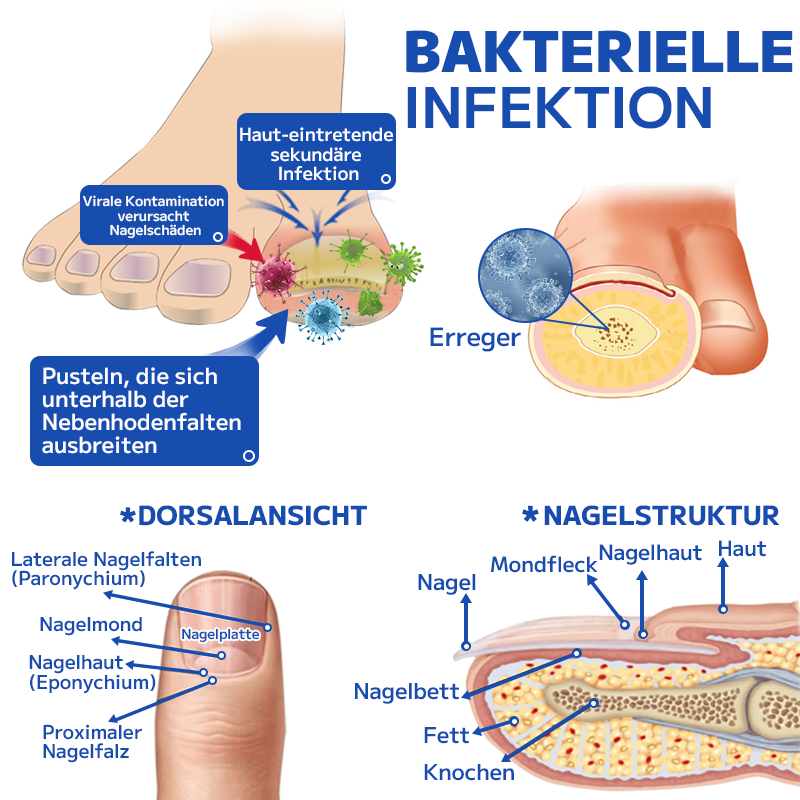 Furzero™ Effektive Pilz-Nagel-Behandlungs-Lasergerät-