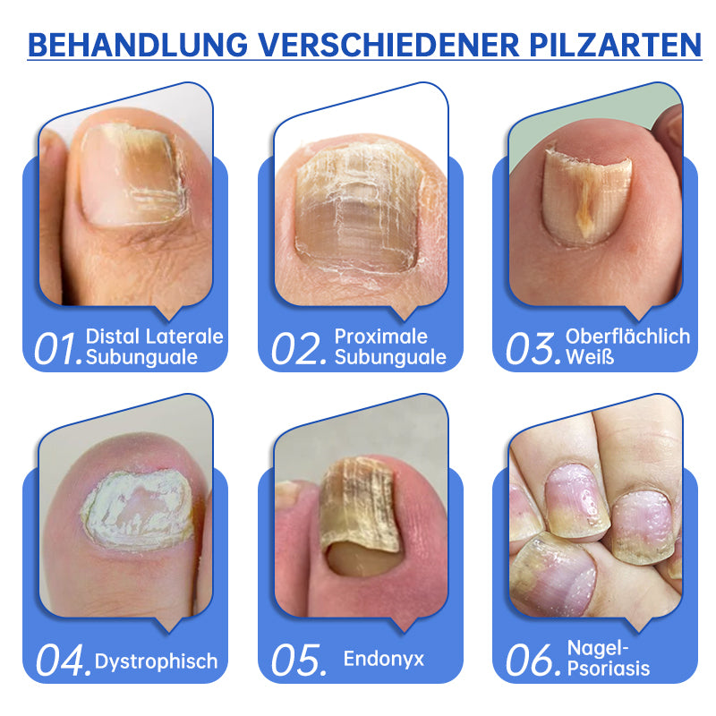 🔥🔥Furzero™ PureNail Pilz-Lasertherapiegerät