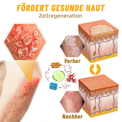 🧑‍⚕️Furzero™ Neuseeländisches Bienengift Psoriasis Behandlungsspray (Geeignet für alle Hauttypen)