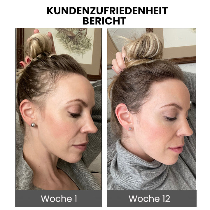 🔥Furzero™ ShougaGRO Japanisches Haarwachstumsspray (🔥Zeitlich begrenzter Rabatt, letzte 30 Minuten)