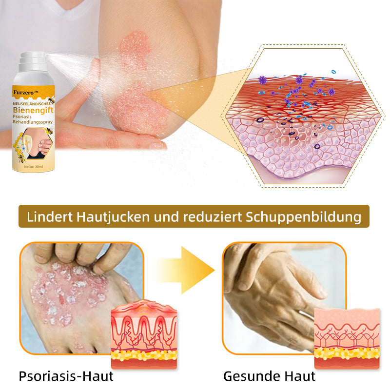 🧑‍⚕️Furzero™ Neuseeländisches Bienengift Psoriasis Behandlungsspray (Geeignet für alle Hauttypen)