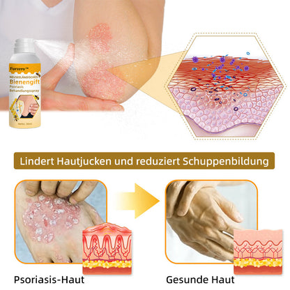 🧑‍⚕️Furzero™ Neuseeländisches Bienengift Psoriasis Behandlungsspray (Geeignet für alle Hauttypen)