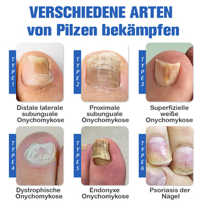 Furzero™ Nagelpilzreinigung Laser Linderungsgerät